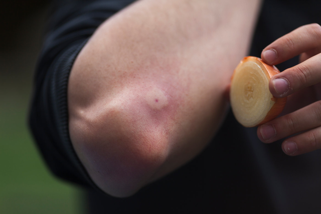 Zwiebeln helfen beim Mückenstich