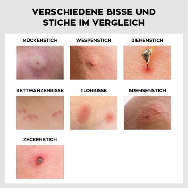 Insektenstiche So lassen sich Stiche erkennen & behandeln DFNT